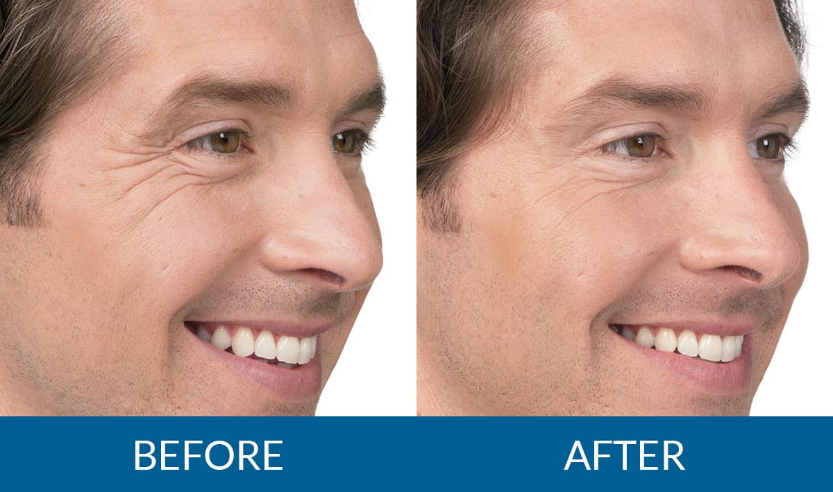 Botox before and after — Jim