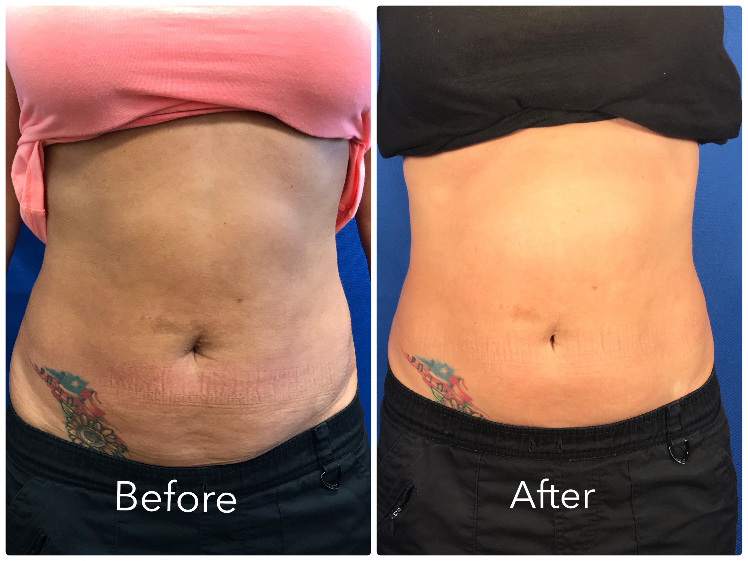 Secret RF Microneedling Dr Durland s Simple Wellness Wellness Made 