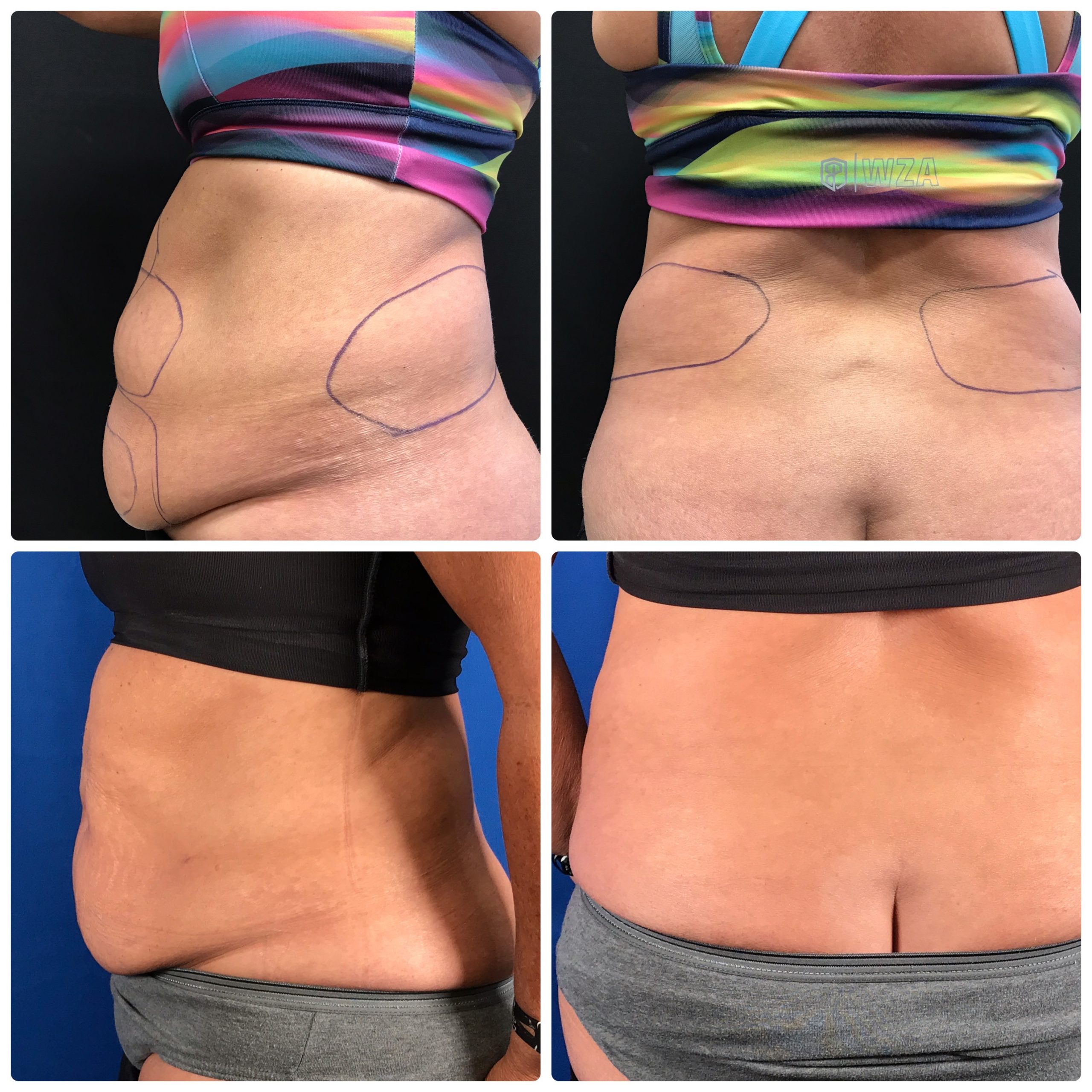 BeautiFill Lipo